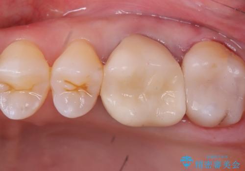 セラミックインレーの症例 治療後