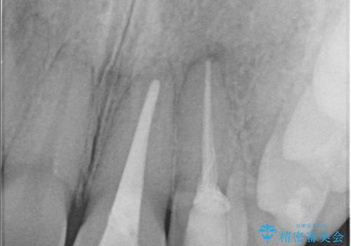 前歯が痛い!|歯の色が気になる!|精密根管治療後、オールセラミッククラウンで審美修復の治療中