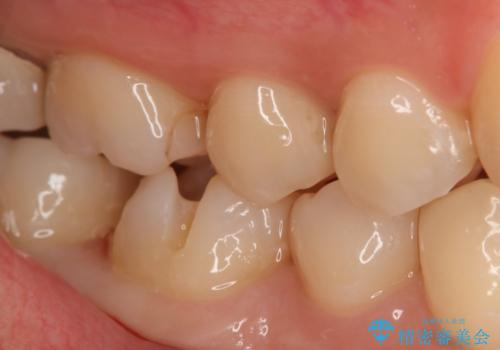 奥歯の虫歯を直したい セラミックインレーの治療中