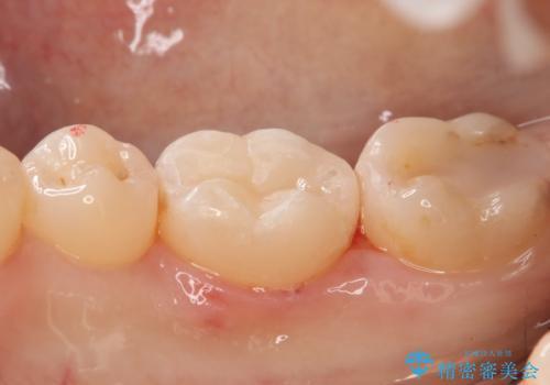 奥歯の虫歯を直したい セラミックインレーの治療後