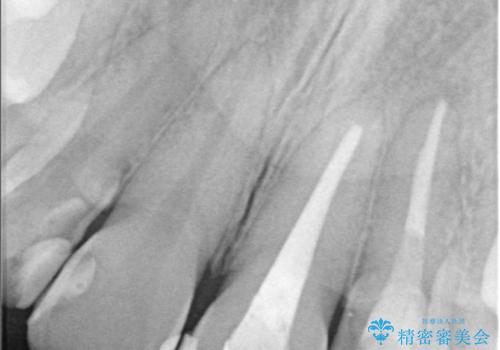 前歯が痛い!|歯の色が気になる!|精密根管治療後、オールセラミッククラウンで審美修復の治療前