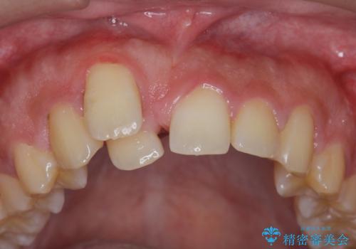 正中過剰埋伏歯で生じた前歯の審美障害 矯正治療での改善の治療前