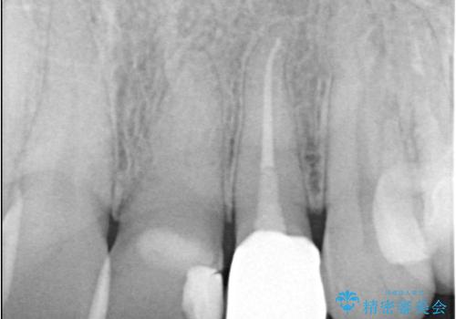 【セラミッククラウン】歯の根元が欠けた、歯が揺れている気がするの治療後