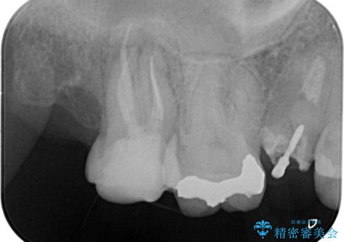 奥歯の根の病変も精密治療で解決の治療後