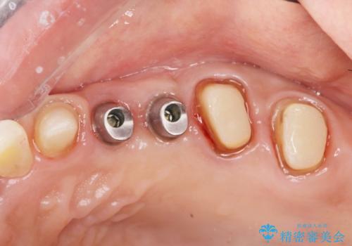 銀歯の除去 長期的な未来を見据えた虫歯治療の治療中