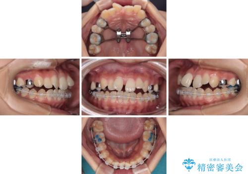 急速拡大装置 狭い骨幅を拡大した上で、口元の突出感を改善する抜歯矯正治療の治療中