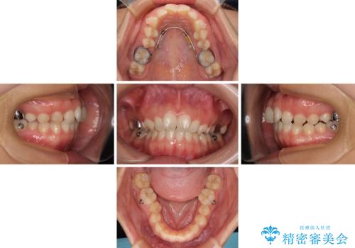 補助装置を併用して確実に インビザラインで奥歯の咬み合わせをしっかりと改善の治療中
