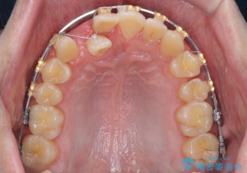 正中過剰埋伏歯で生じた前歯の審美障害 矯正治療での改善の治療中