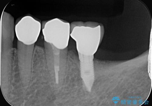 【セラミッククラウン】知覚過敏をどうにかしてほしいの治療後