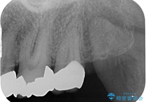 かぶせ物が外れたまま放置 伸びてしまった歯を修復の治療後
