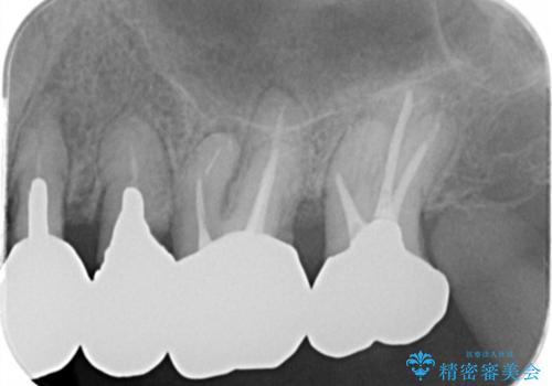 銀歯の除去 長期的な未来を見据えた虫歯治療の治療前