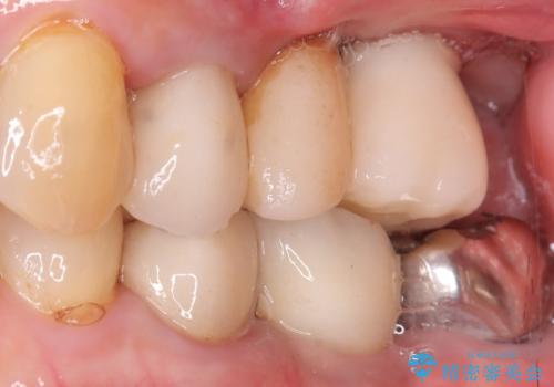 【インプラント】噛んだら痛みがあるの治療後