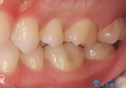 【セラミックインレー】歯科検診で虫歯が見つかったの治療後