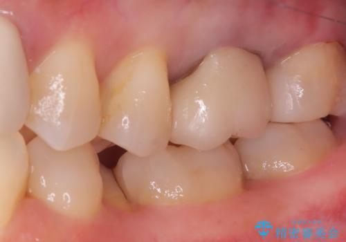 【セラミックインレー】口の中から金属を無くしたいの治療後