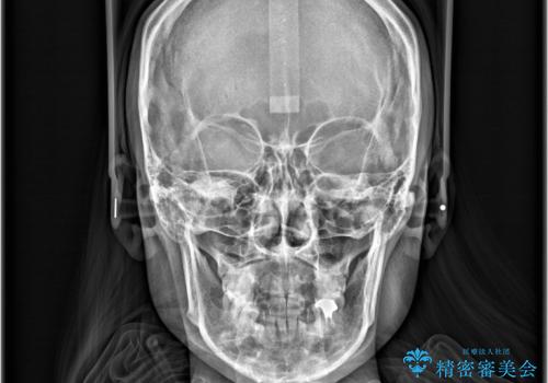 歯のデコボコ|口ボコ|八重歯が気になる!|ワイヤー矯正の治療後