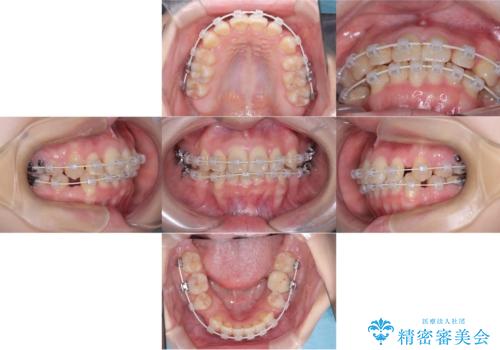 歯のデコボコ|口ボコ|八重歯が気になる!|ワイヤー矯正の治療中