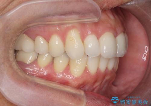 矯正と虫歯のセラミック治療 総合歯科治療の実践の治療後