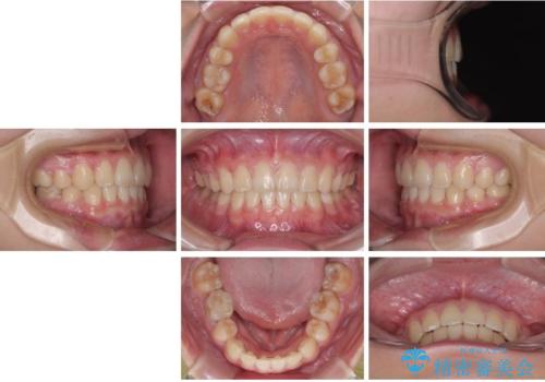 転勤でも安心して治療継続 抜歯スペース閉鎖と深い噛み合わせ改善のワイヤー矯正の治療後