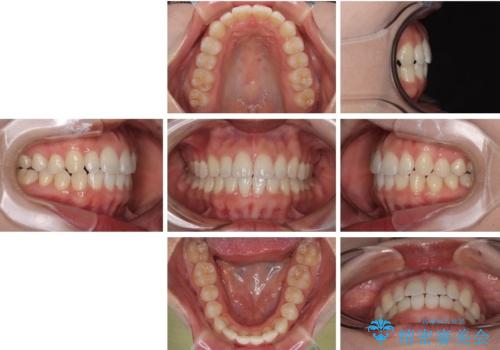 目立ちにくい表側装置で1年完了!狭いアーチを側方拡大し前歯のデコボコを整えた症例の治療後
