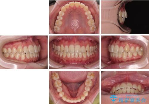 【モニター】前歯のデコボコをスッキリ解消!目立ちにくいワイヤー矯正でスピーディに治療完了の治療後