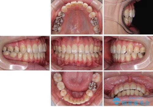 口元の突出感を改善!目立ちにくいワイヤー矯正で自信を持てる自然な横顔にの治療後