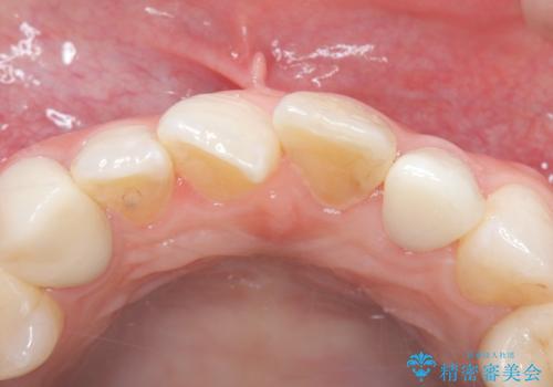 【セラミッククラウン】歯の根元が欠けた、歯が揺れている気がするの治療後