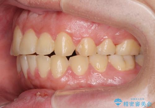 正中過剰埋伏歯で生じた前歯の審美障害 矯正治療での改善の治療後