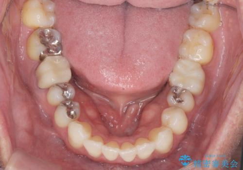 矯正と虫歯のセラミック治療 総合歯科治療の実践の治療後