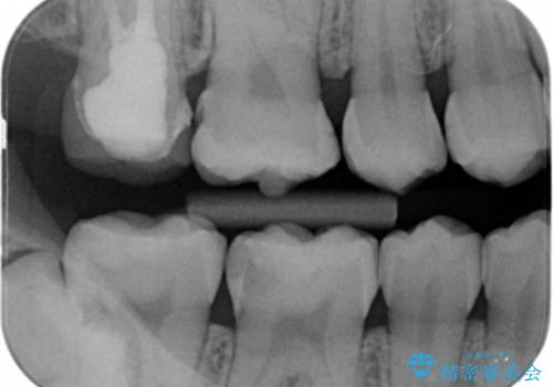 奥歯の虫歯を直したい セラミックインレーの治療前
