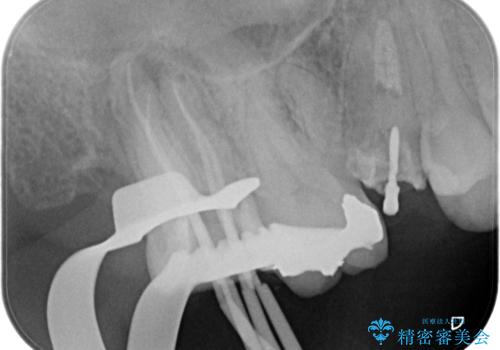 奥歯の根の病変も精密治療で解決の治療中