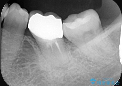 銀歯が取れた 〈セラミックインレー〉の治療後