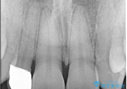 前歯の見た目が気になる!|矮小歯をオールセラミッククラウンで綺麗な形に!|審美回復の治療後