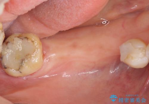 失った奥歯をインプラントで機能回復の治療前