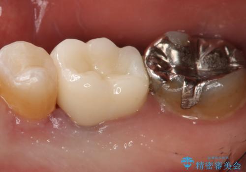 奥歯が痛む オールセラミッククラウンの治療前