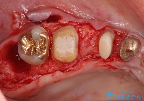 歯周ポケットの除去を併用したセラミック治療の治療中