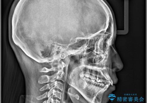 口ボコと歯のデコボコが気になる!|前歯が出ていて口が閉じにくい|審美ワイヤー矯正による口元の改善!の治療前