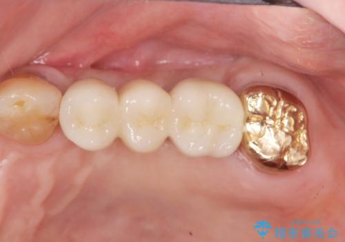 入れ歯では食事を楽しめない。インプラントによる咬合機能回復の治療後