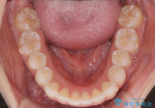 前歯のがたつき気になる。インビザラインモデレートの治療中