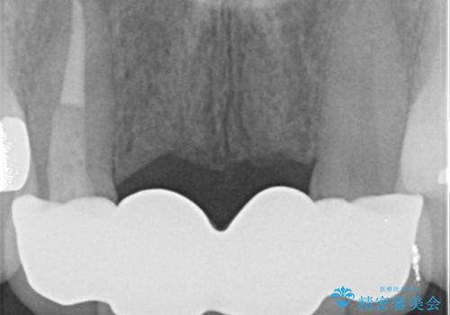 [ 前歯セラミックブリッジ治療 ]  転んで抜けた前歯 、見た目をきれいにしたいの治療後