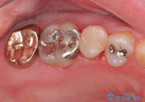 右奥歯治療が必要と言われた。の治療後