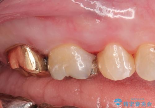 右奥歯治療が必要と言われた。の治療後