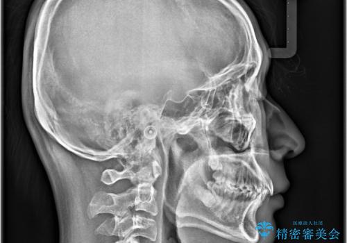 必ずしもワイヤーでなくても大丈夫!インビザラインでデコボコ歯列&過蓋咬合を改善の治療後