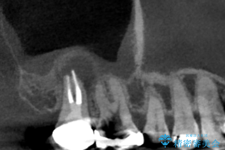 右奥歯治療が必要と言われた。の治療後