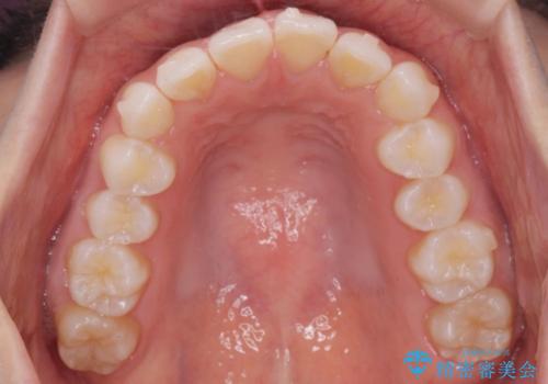 前歯のがたつき気になる。インビザラインモデレートの治療中