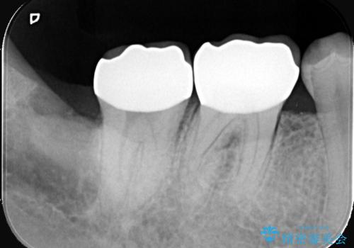 歯の根元の虫歯も精密治療で解決の治療後