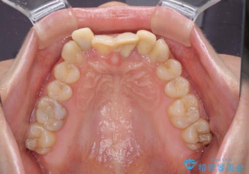 気になっていたむし歯と前歯のデコボコ 矯正治療とむし歯治療の総合歯科治療の治療前