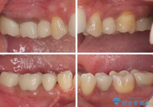 新幹線通院 地元で断られた奥歯のむし歯治療の治療後
