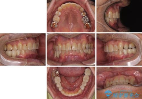 奥歯の欠損と前歯のデコボコを治したい インプラントと矯正治療の総合歯科治療の治療後