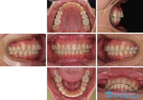 銀歯を白くしたい 一緒に矯正治療も行ない美しい口腔内にの治療後