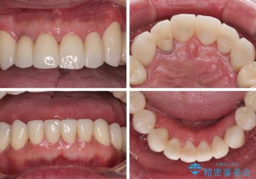 強い咬合力で奥歯がボロボロに インプラント治療による咬合回復と全顎セラミック治療の治療後